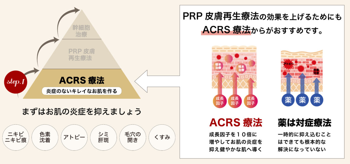 ACRS療法図解