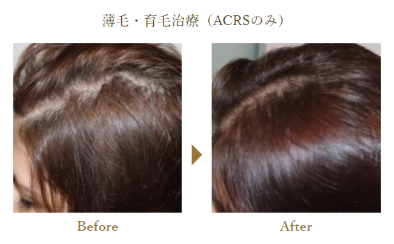 ACRS療法　薄毛・育毛治療