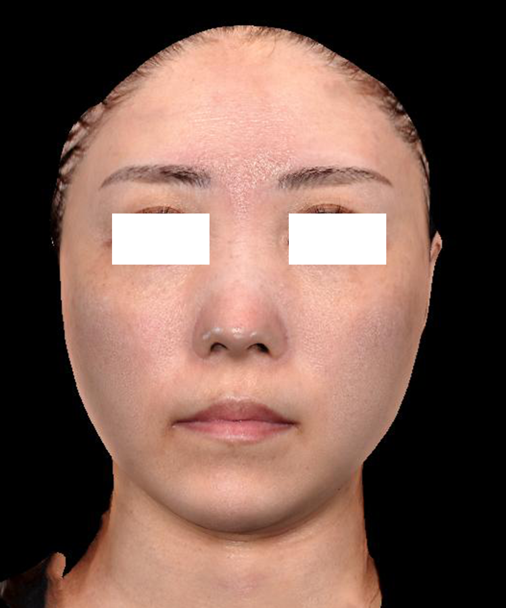 症例No.81施術前の画像