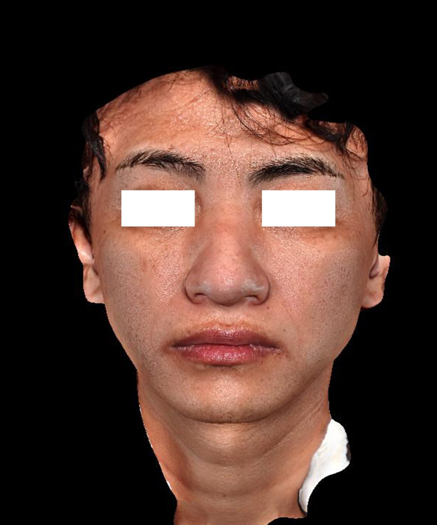 症例No.82施術後の画像